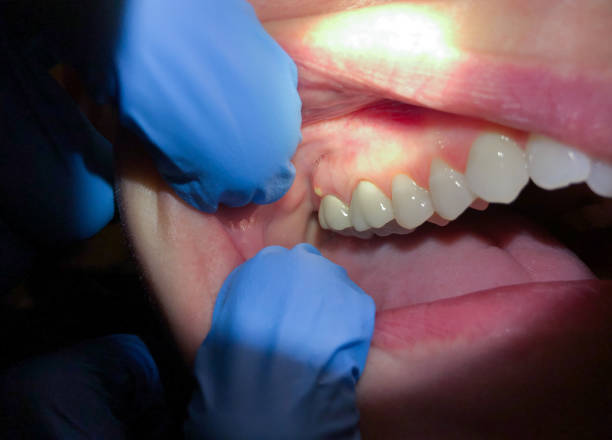 Best Emergency Dental Care for Abscessed Tooth in Rome, GA